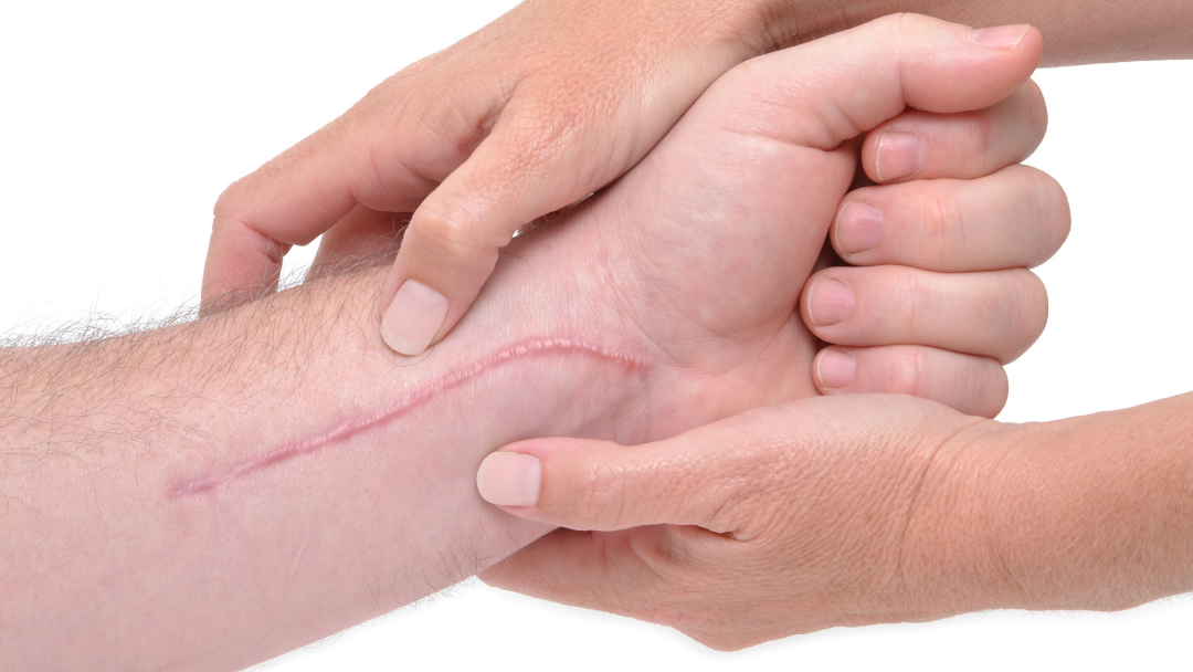 Scarwork therapist scar wrist